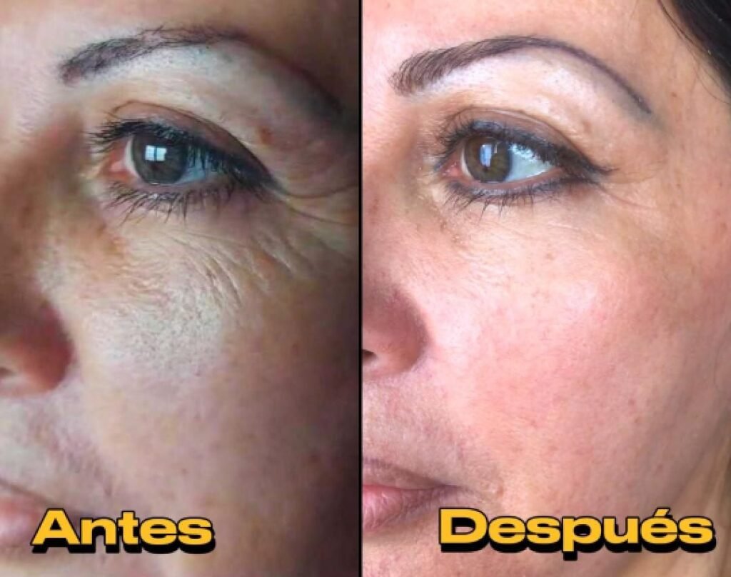 Antes y Despues Plasma Pen