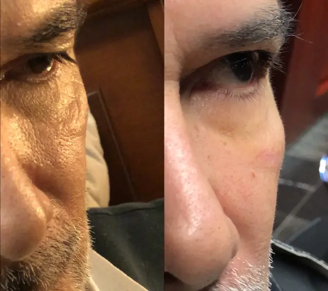 Fibroblast en Madrid Plasma Pen